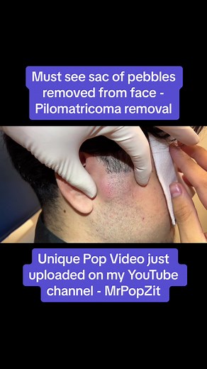 Giant sac of pebbles (pilomatricoma) removed from face. Must see Video just uploaded on my YouTube channel. #medicaleducation #dermatology #mrpopzit #mrpopzitlive #skincare #skin #youtube #popaholic #dermatologypa #physicianassociate #physicianassistant #youtuber #pilomatricoma