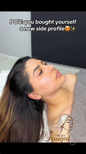 Double Chin Liposuction: Before and After Transformation
