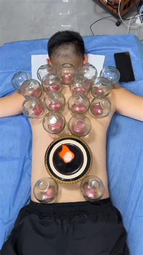 Immersive Cupping Therapy: Listen to the Jar Drop Sound