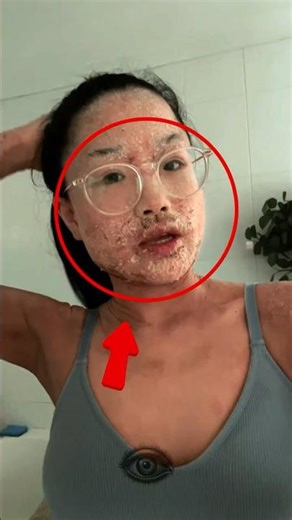 Extreme Flaky Skin! 😳