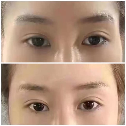 Adding dermal filler to the temples can provide several aesthetic and structural benefits. It’s actually one of the more underrated areas of the face, but it makes a big impact when done correctly. Here’s why: 1. Restores Volume Loss As we age, the temples often hollow out. This creates: • A more tired or gaunt appearance • Sharper transitions between the forehead and cheeks Temple filler replenishes that lost fat and soft tissue, helping the face look more youthful and balanced. 2. Lifts the Ou