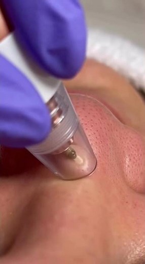 Professional Blackhead Removal on Nose: Deep Pore Cleaning Extraction