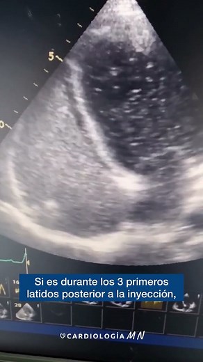Bubble test by echocardiography #cardiology #echocardiography #medicine #health
