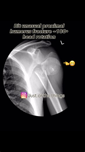 Just Ortho Things on Instagram: "Follow up of an unusual 4 part proximal humerus fracture in a 55 year old active male. 4-Part Proximal Humerus Fractures – Basic Tips 🔍 Assessment & Planning Suspect high risk of avascular necrosis (AVN) due to disruption of humeral head blood supply Carefully assess patient age, bone quality, functional demand, and comorbidities Obtain true AP, scapular Y view /axillary view; add CT with 3D reconstruction for surgical planning Identify head-split component, med