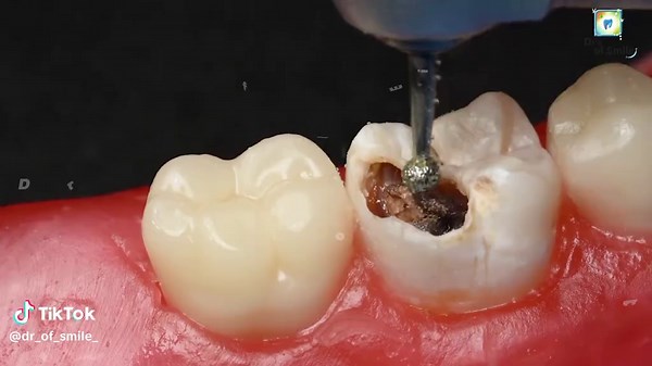 Lower First Molar Root Canal Treatment Explained