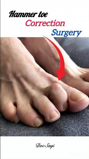 Hammer toe correction surgery| #hammertoes #ortho #surgerysuccess #shorts #medical #health #trending