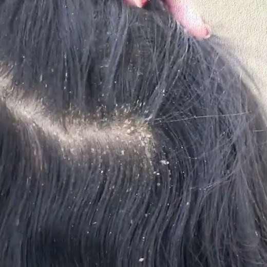 BIG DANDRUFF FLAKES Scalp scratching and picking Satisfying Dandruff Removal by Doctors 9