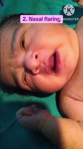 Nasal flaring l Baby with breathing difficulty #nasalflaring