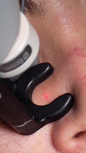 Effective Laser Treatments for Capillary Removal