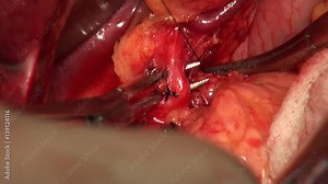 Total gastrectomy. Doctor stitching and tightening of stomach