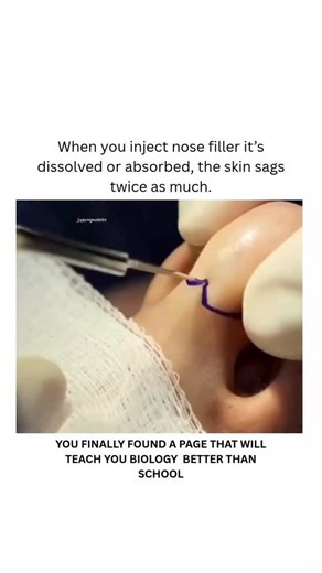 BIOLOGY | HEALTH | MEDICAL on Instagram: "Fillers do not cause permanent skin sagging simply by dissolving. Temporary stretching and volume loss can make pre-existing skin laxity more noticeable, but the filler itself rarely creates irreversible stretch injury to the skin. Dm for credit or removal 🙏 For educational purposes only....... #viral #explore #science #knowledge #biology #bio #medical #nose #fillers #insane"