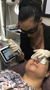 52K views · 158 reactions | Fraxel laser Skin Resurfacing is an...