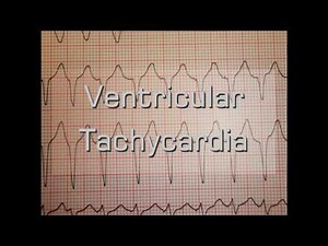 Ventricular Tachycardia
