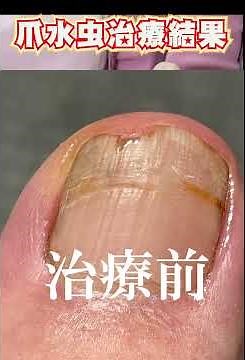 【つめ水虫】旦那の「爪水虫」治療報告！諦めません治るまで！【郡上の保健室 カトー薬局】