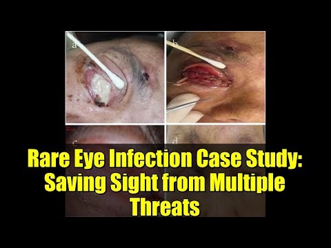 Rare Eye Infection Case Study: Saving Sight from Multiple Threats