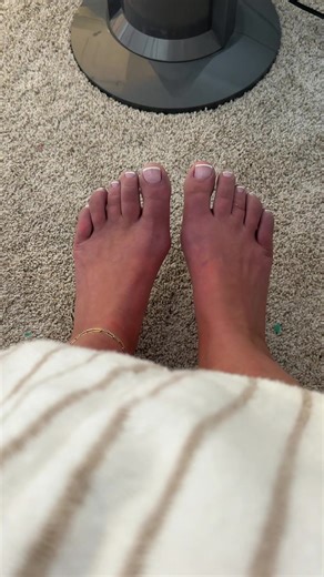 Living with Arthritis and Purple Toes