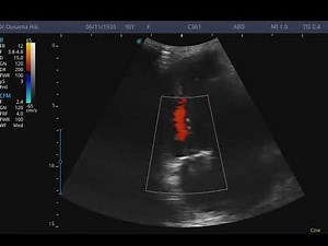 Low flow Low gradient Aortic Stenosis. Paradoxical IVS motion, severe PAH, Echocardiography