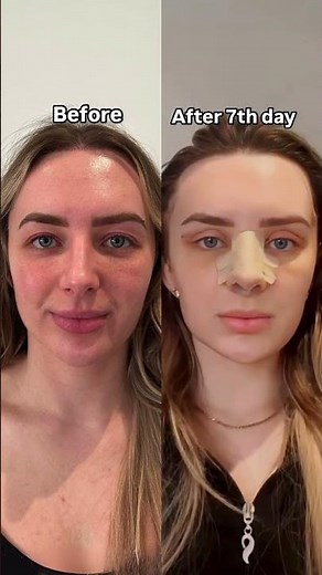 Cat Eye Surgery Before & After 👁️✨