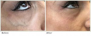 Sclerotherapy Under Eye Vein Removal - Blue Veins Under Eye