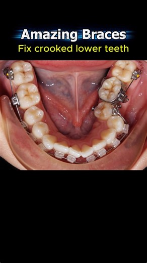 Crooked lower teeth and braces process. Does your teeth look like this? #braces #orthodontics #teeth