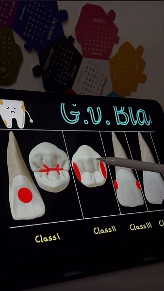 Dr.Adyan | G.V. BLACK’S CLASSIFICATION OF CARIES | Instagram