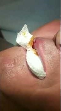 Botfly Larva Removal from lip