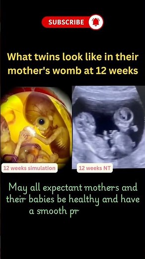 Twins at Week 8 | 2 Month Ultrasound Scan