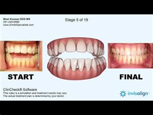 Invisalign open bite correction with Surgery