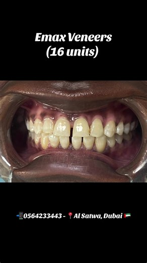 ✨ Emax Veneers Smile Transformation ✨ A complete smile upgrade using premium Emax veneers — designed for a natural look, perfect shade, and long-lasting strength. Every smile is custom-made to enhance facial harmony and boost confidence. 📞 Book your consultation today: 056 423 3443 📍 Skin & Smile Dental Clinic | Al Satwa, Dubai #EmaxVeneers#SmileTransformation #BeforeAndAfterSmile #SmileMakeoverDubai #DubaiDentist