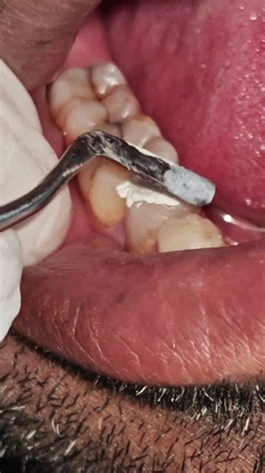 Temporary filling Cavit #dental #dentist #satisfying