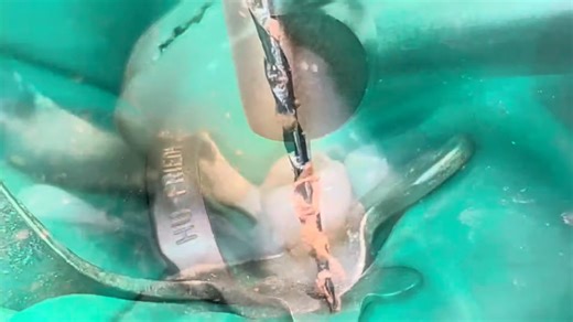 Endodontic Retreatment lower 2nd premolar (Reciproc Blue)