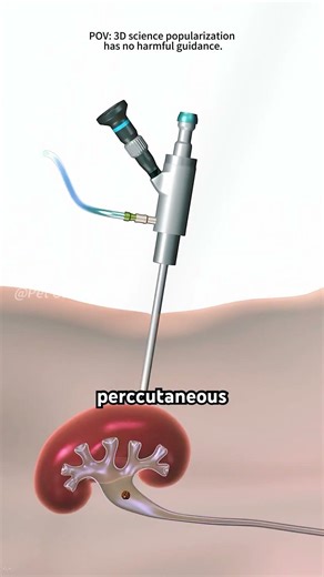 Kidney Stones Removal Surgery | Percutaneous nephrolithotomy (PCNL) (3D Animation)