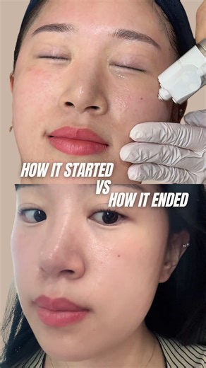 This glow wasn’t luck — it was non-needle skin boosting done right. She had DermaJet (needle-free injector) to infuse Juvelook Rejuran deep into the skin without needles, without downtime, and without trauma. 💧 Juvelook A collagen-stimulating skin booster that improves texture, elasticity, and overall skin quality over time — perfect for pores, fine lines, and dull skin. 💉 Rejuran Salmon DNA (PN) that repairs the skin barrier, boosts regeneration, and helps skin heal stronger and healthier fro