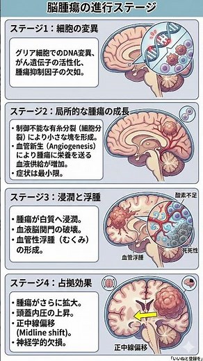 【脳腫瘍】ステージ1〜4の進行メカニズムを徹底解説！DNA変異から脳のむくみ、占拠効果まで知っておくべき真実