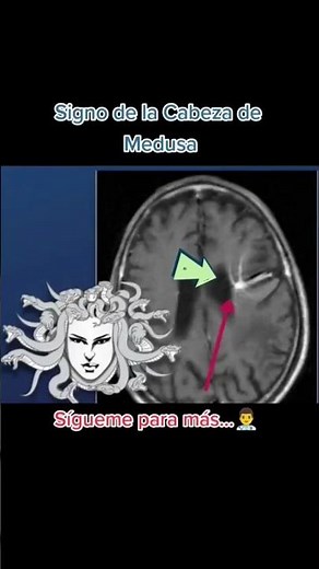 Signo de la cabeza de Medusa #medicina #sabiasque #medstudent