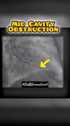 MidCavity Obstruction on Ventriculogram #heart #shorts