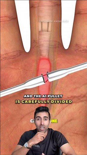 What Really Happens During Trigger Finger Surgery