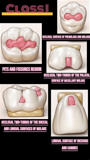 G.V. Black Classification of Dental Caries | Dr.Dentique-hub
