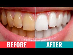 Yellow Teeth? Here’s How to Get a Whiter, Brighter Smile Safely