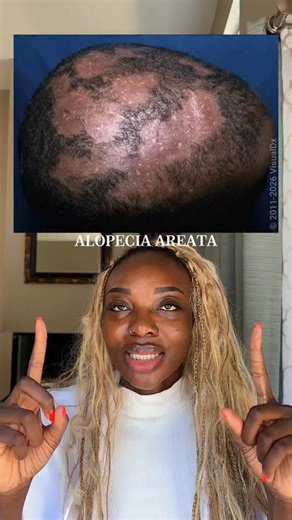 Phia, MD | Dermatology Resident on Instagram: "Alopecia areata is a T lymphocyte-mediated autoimmune disease of the hair follicle resulting in nonscarring hair loss. Most cases are limited to 1 or 2 small patches of alopecia that involve the scalp, eyebrows, eyelashes, or body hair, but in severe cases, all hair on the scalp is lost (alopecia totalis) or all scalp and body hair is lost (alopecia universalis). History of sudden onset is characteristic."