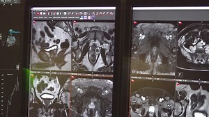 Doctors recommend prostate cancer screenings for most men over 50