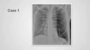 How to identify pneumothorax on a chest x-ray | Medmastery