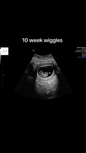 Look at all this movement at just 10 weeks 🥹#fyp #babiesoftiktok #pregnantlife #kcmoinfluencer #10weekspregnant