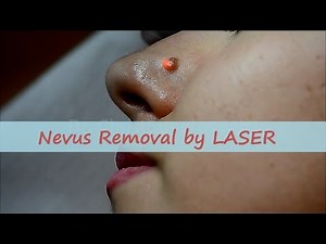 Mole (nevus) removal by LASER LIVE