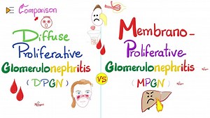 Diffuse Proliferative Glomerulonephritis (DPGN) vs Membranoproliferative Glomerulonephritis (MPGN)..Nephrotic-Nephritic Syndrome Subtypes. Medicosis Lectures for MCAT, USMLE, NCLEX, DAT, NEET. | Medicosis Perfectionalis