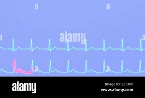 ECG comparison of normal heart rhythm and AV block. Animation 3D render Stock Video Footage - Alamy