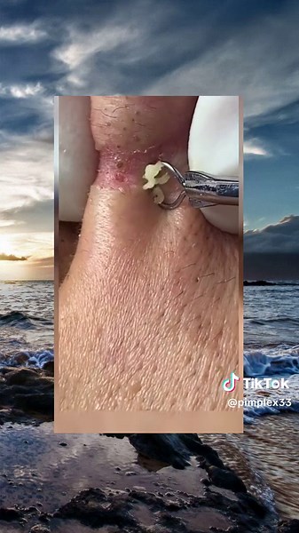 popping satisfying acne viral pimple squeeze pimplepop foryou (322)