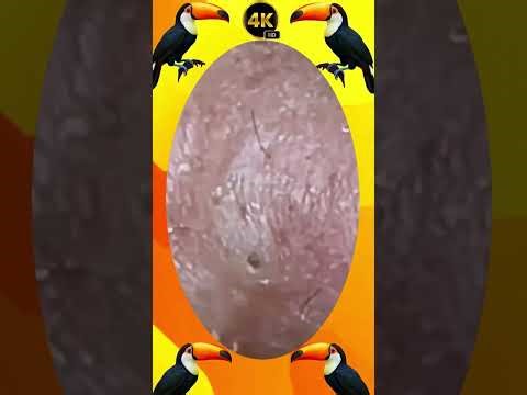 Blackheads Removal | Acne Treatment and Very Satisfying Satisfying Pimple pop #blackheads