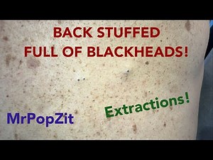 Back full of blackheads! Mining the pores for keratin plugs and ingrown hairs! ASMR relax and sleep