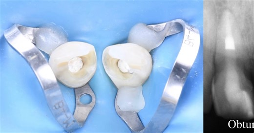 Dr. Oksana Bochko | Люблю MTA💙 МТА (Mineral Trioxide Aggregate) одним из самых удобных и эффективных материалов в современной эндодонтии. Благодаря высокой... | Instagram